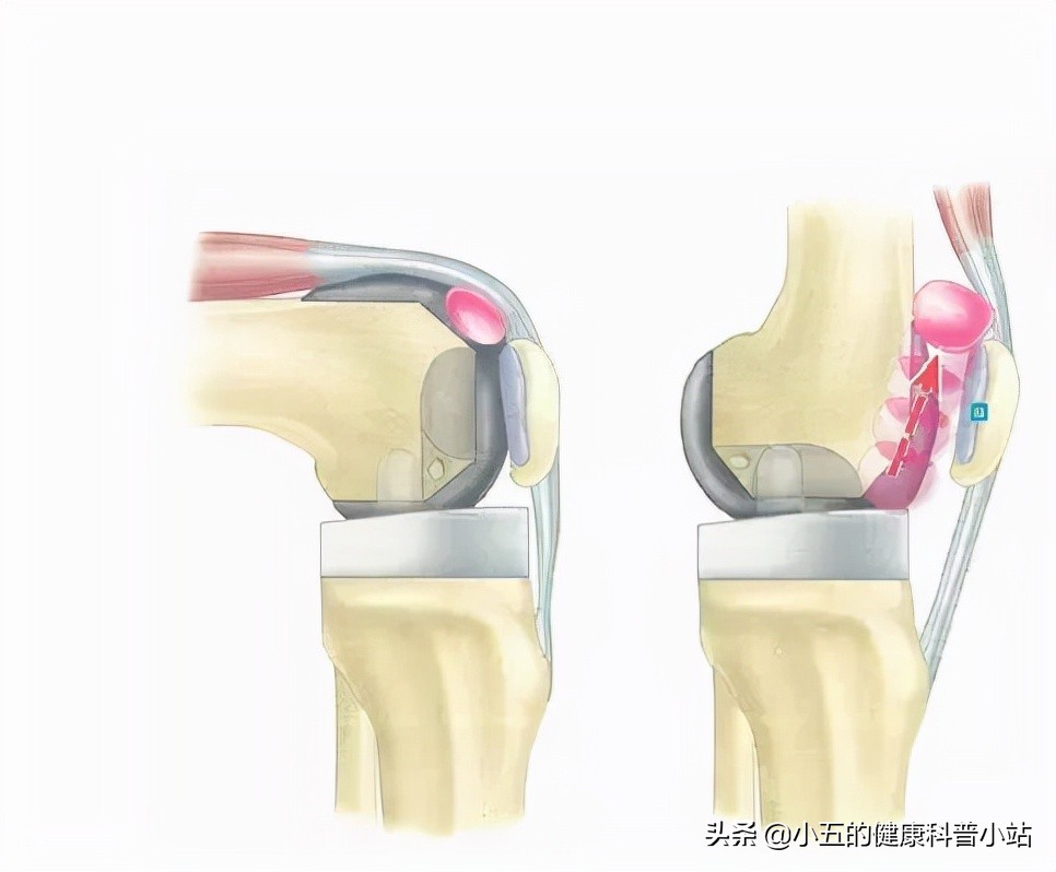 膝关节咔咔作响怎么回事,膝盖痛髌骨软化症怎么治疗