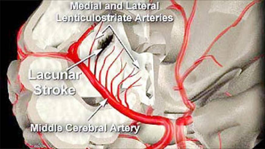 腔隙性脑梗死是怎么造成的,腔隙性脑梗死是怎么回事