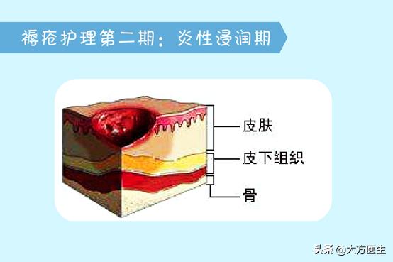 长年卧床得褥疮用什么方法好得快,病人久睡的褥疮怎么治疗