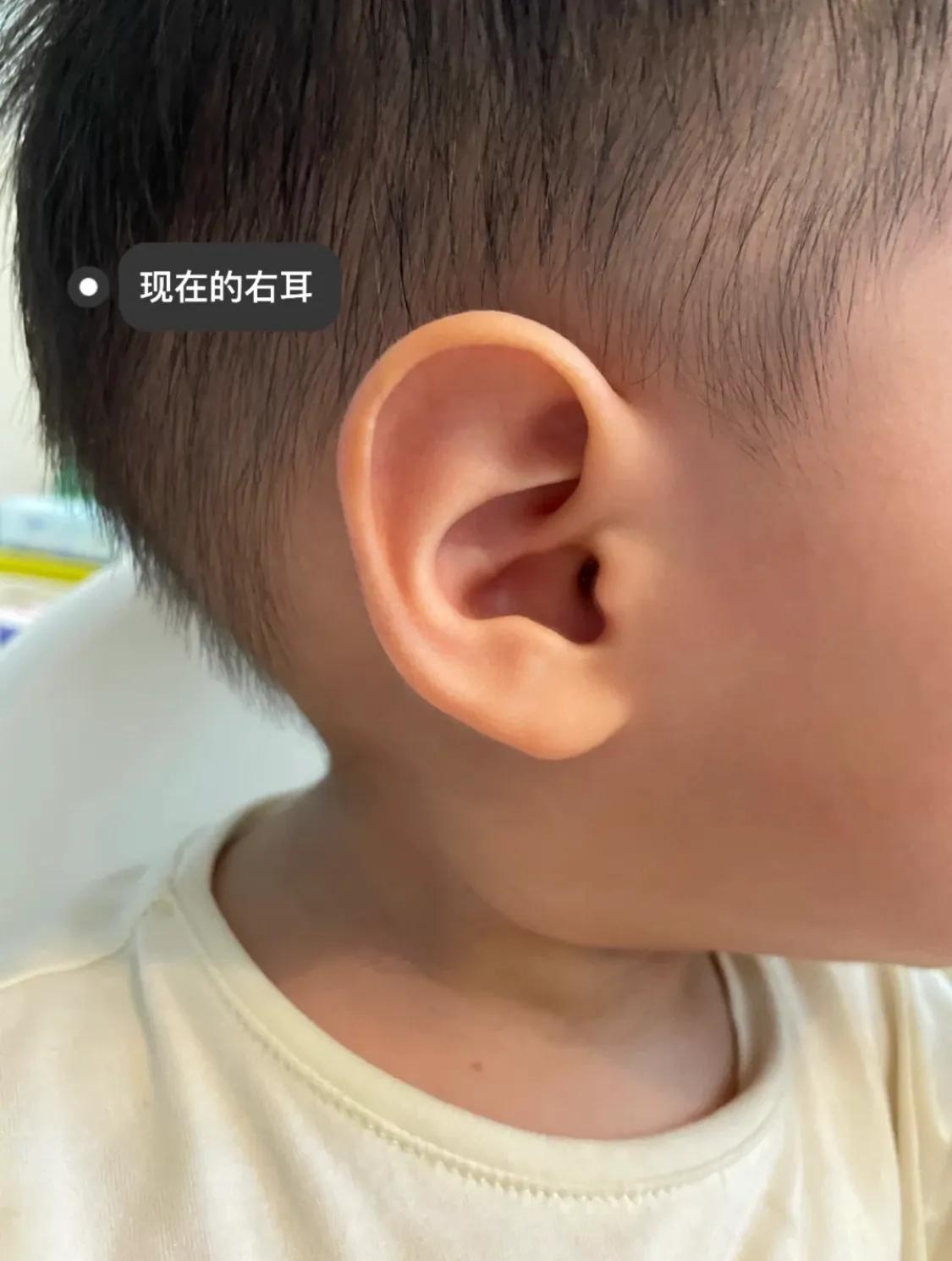宝宝刚出生耳廓畸形，现在长成什么样了？