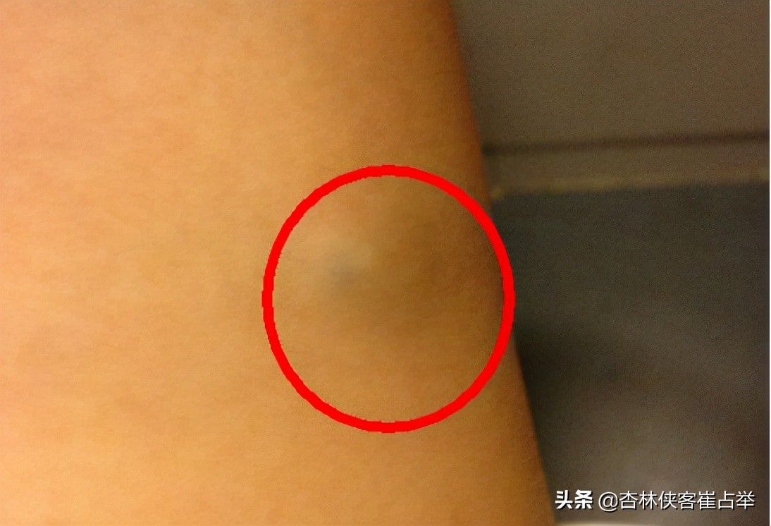 身上有脂肪瘤吃什么好,胳膊上的脂肪瘤吃什么药才能消掉