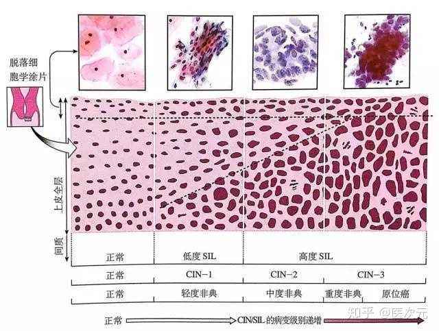 人乳头瘤病毒E6/E7mRNA与宫颈病变关系的研究进展
