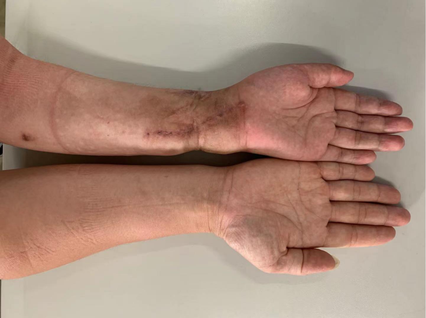 爬树跌倒骨折敷草药误事竟致手部严重畸形20年