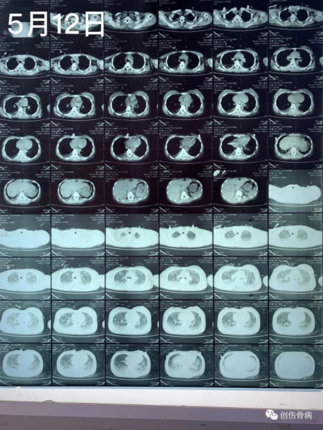 脂肪填充栓塞概率,脂肪填充栓塞几率