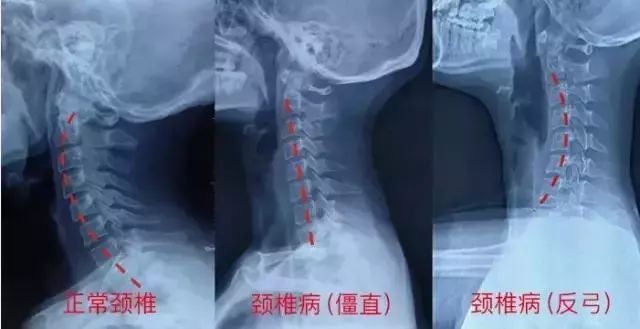 颈椎病到底多严重？出现这些症状你就该当心了，日常护理很重要