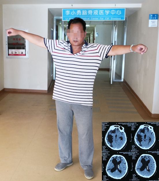 脑外伤开颅手术后脑积水,脑外伤手术后脑脊液鼻漏怎么治疗