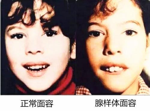 孩子睡觉张口呼吸上嘴唇翘,宝宝张嘴呼吸上嘴唇翘