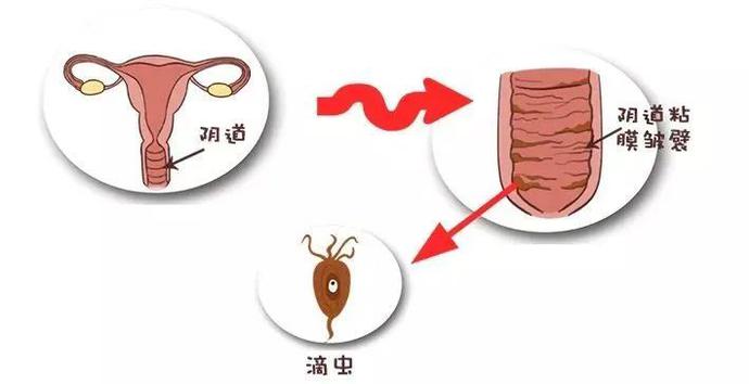 阴道炎传染给伴侣有何症状,阴道炎传染给伴侣会有什么症状