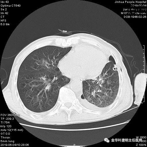手术引起乳糜胸,有没有做了肺结节手术后是误诊的