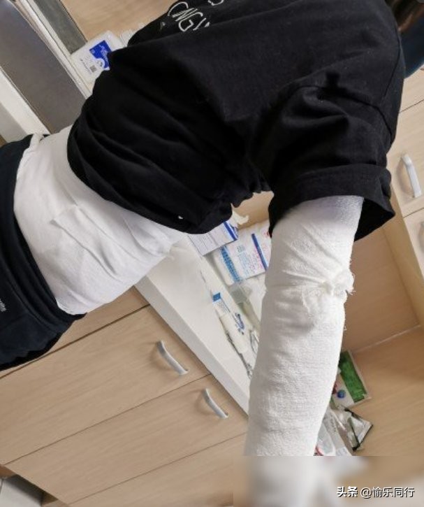 邓莎被火罐烧伤的电影,邓莎拔火罐被烧伤后续