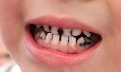 给孩子补个牙，竟花了两万多