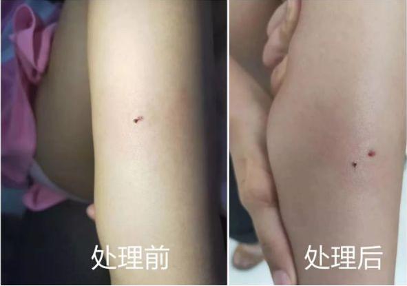 被蜜蜂蛰了100多针的女孩后续,小女孩被蜜蜂蛰了