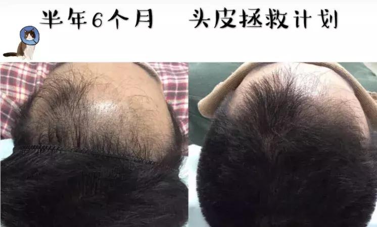 发际线高头发稀疏掉头发怎么拯救,发际线后移的头发还能长出来么