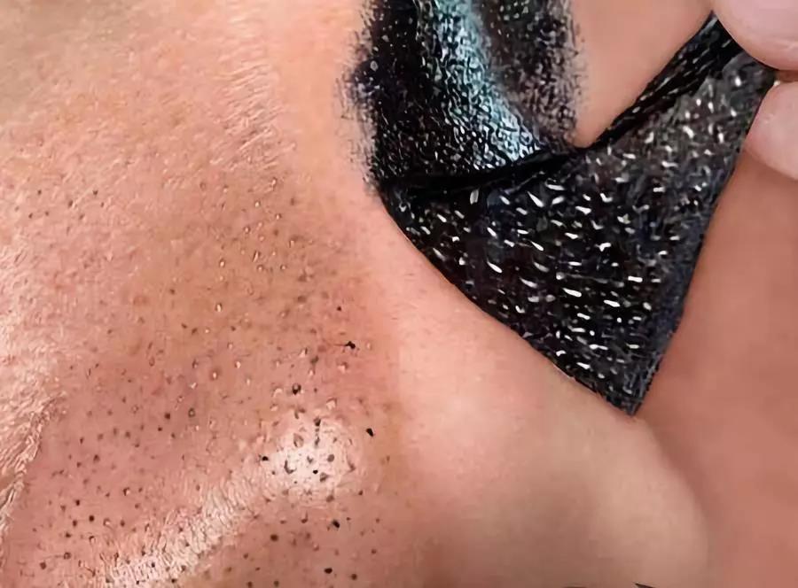 一秒去黑头去粉刺,一步就能搞定的黑头