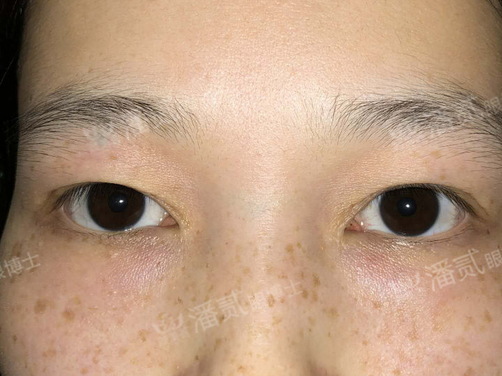 开眼角手术如何避免回缩,开眼角手术常见问题及解决方法