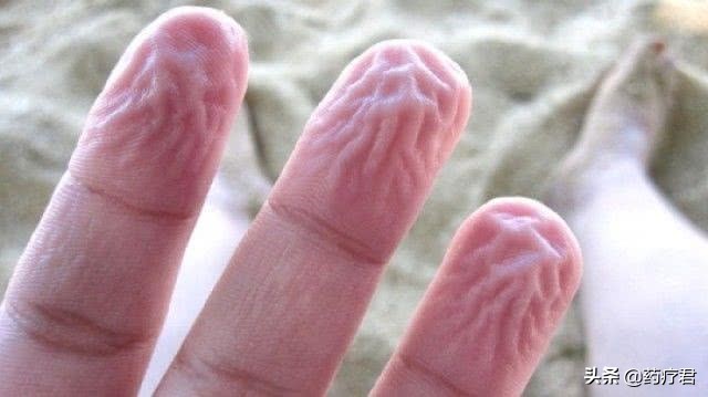 手指发皱不泡水也皱,手指一泡水就皱这说明什么