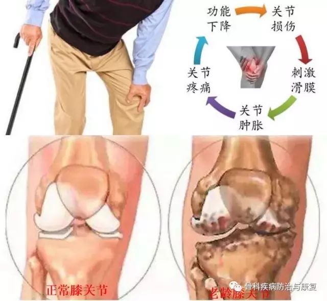 滑膜炎十大常见骨科疾病,骨科专家治滑膜炎偏方