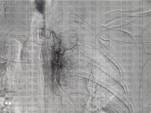 广药三院肿瘤科治头颈癌吗,广药三院肿瘤成功案例