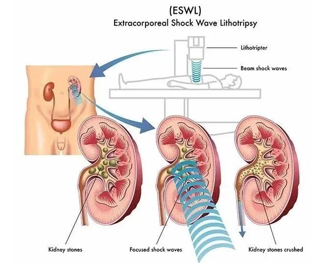 胆总管结石开刀手术一般多少费用,结石是做手术好还是保守治疗好
