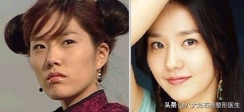 太阳穴凹陷除了填充还有什么办法,太阳穴填充的明星