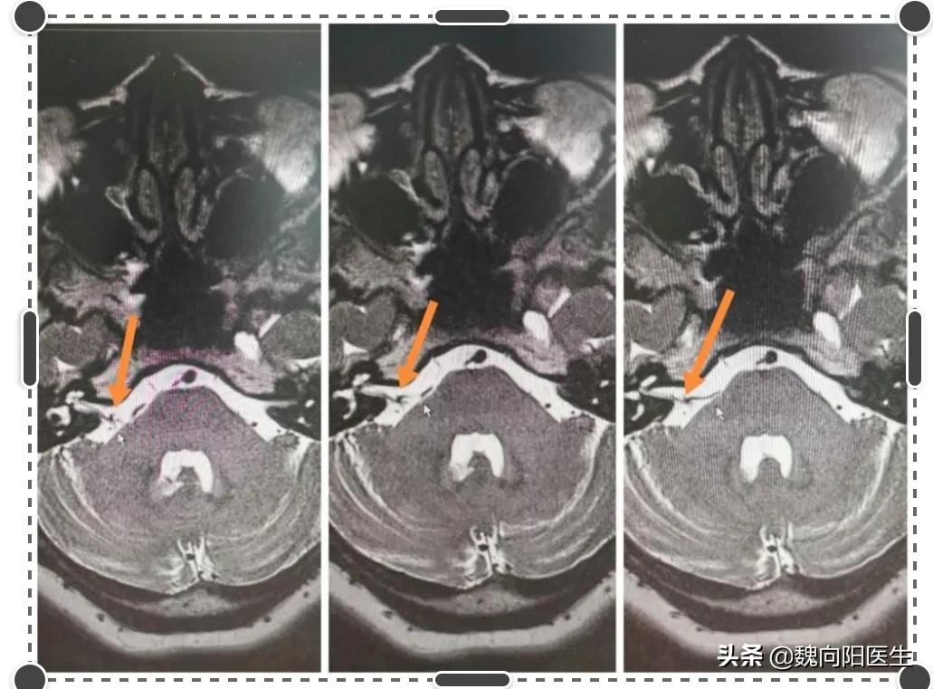 面部痉挛手术后半年又开始跳动,面部痉挛微创手术后走路不稳