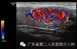 甲状腺良性腺瘤做消融好吗,甲状腺囊性腺瘤用做手术吗