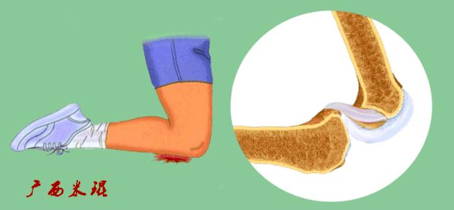 交叉韧带损伤的mr表现,后交叉韧带损伤的诊断实验