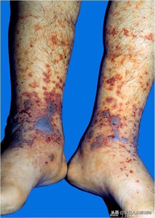 孩子腿上都是湿疹,宝宝腿上大面积皮疹