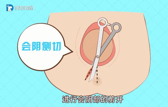 怎样避免顺产侧切,顺产为何都要侧切