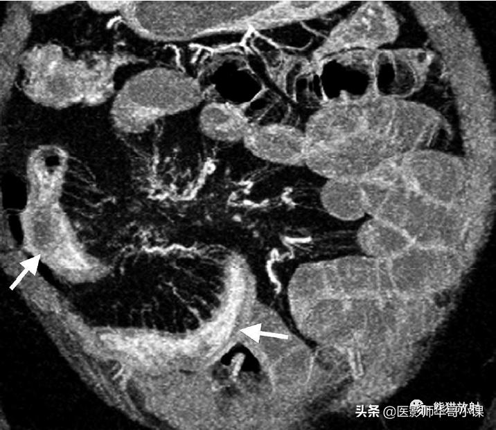 「精品课件」11种腹膜感染/炎症性病变的影像学表现