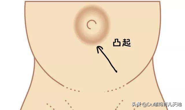 婴儿脐疝贴使用方法,婴儿脐疝应该怎么办