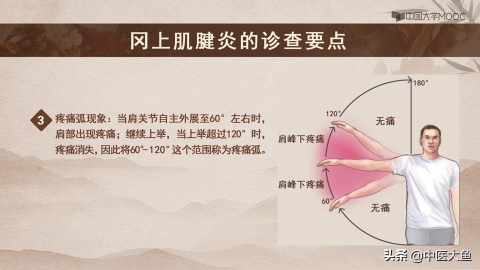 冈上肌腱炎的体征,冈上肌肌腱炎的症状及治疗
