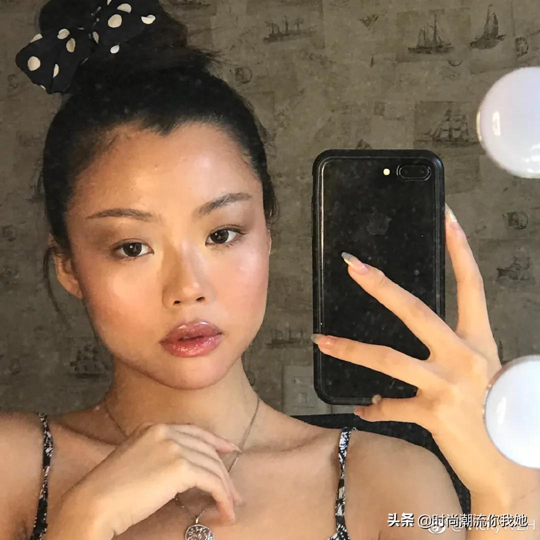 单眼皮凸嘴素人改造,肿眼泡整容成功案例