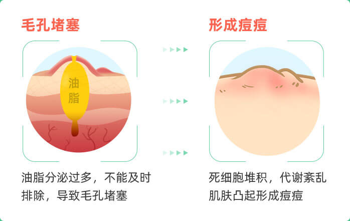 脸上油脂粒怎么护肤,脸上油脂粒挤出黄色颗粒