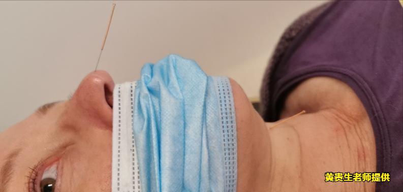 古派针灸，在欧洲治疗因痛经多次手术留下的后遗症