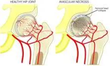 股骨头坏死和腰间盘突出症状区别,椎间盘突出和股骨头坏死症状区别