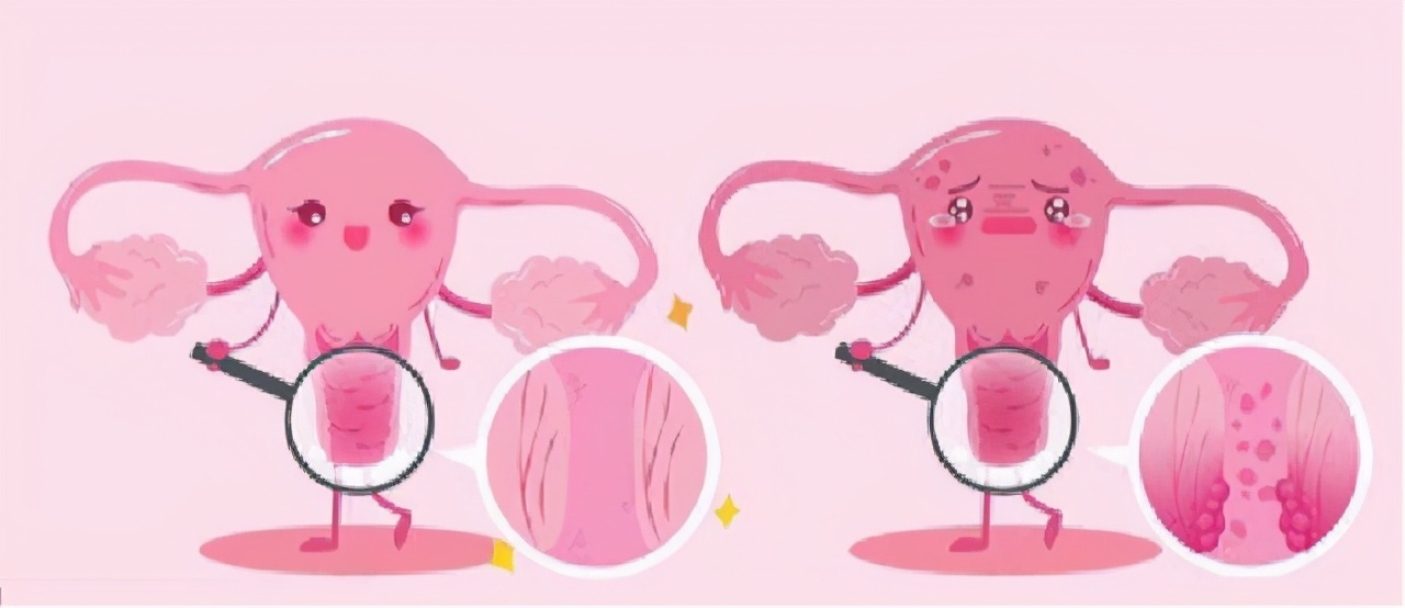 女性腿疼是宫颈癌的早期前兆吗,宫颈癌晚期腿肿腿痛还能活多久
