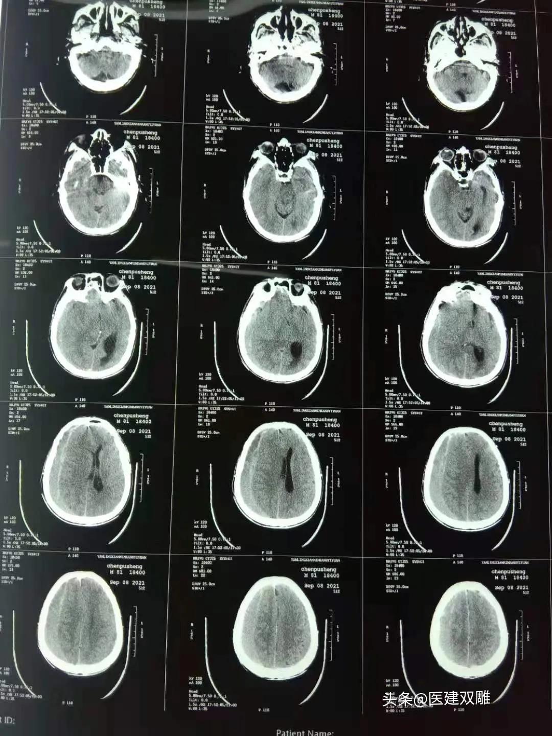 病例分享案例,硬膜下血肿病例