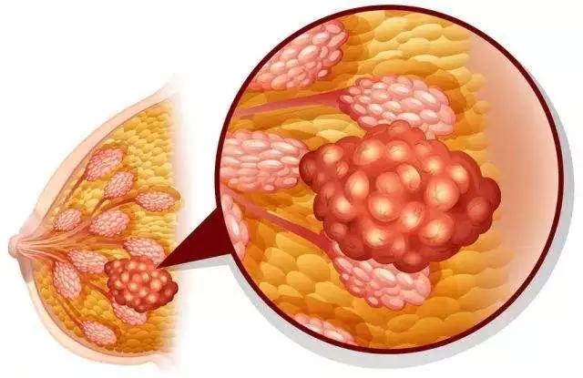 息肉囊肿结节和肌瘤的区别,结节息肉囊肿哪个容易癌变