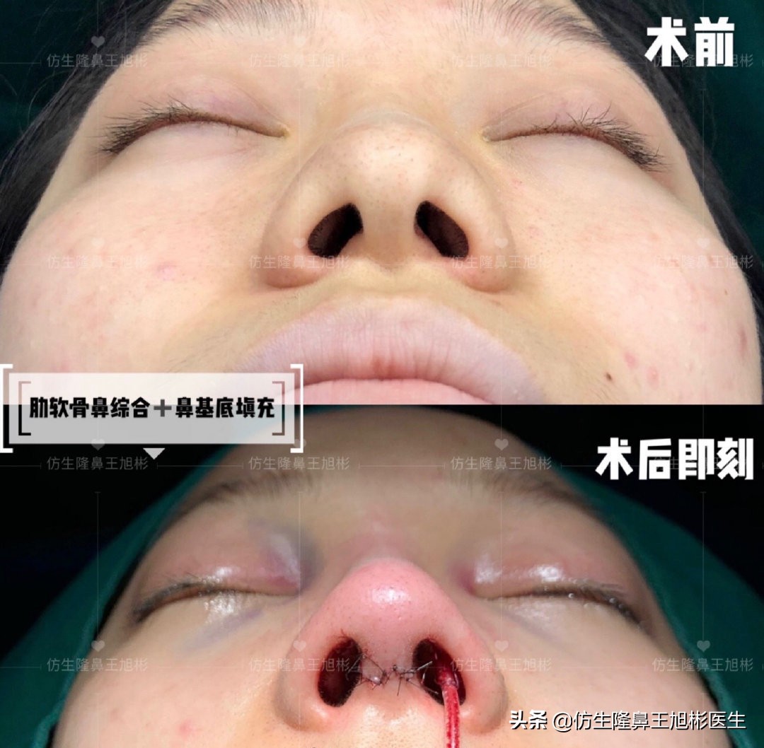 外切缩鼻翼的后遗症,外切鼻翼缩小会回弹吗
