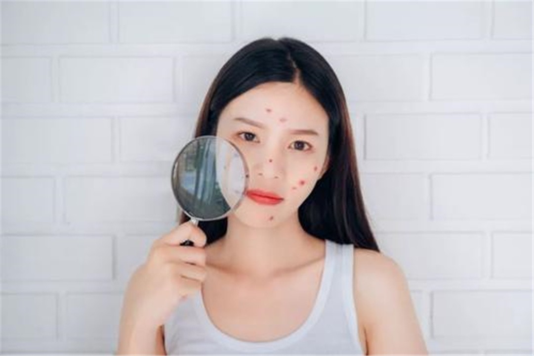 “危险三角区”的痘痘千万不能挤！有人挤了一下，结果留下后遗症