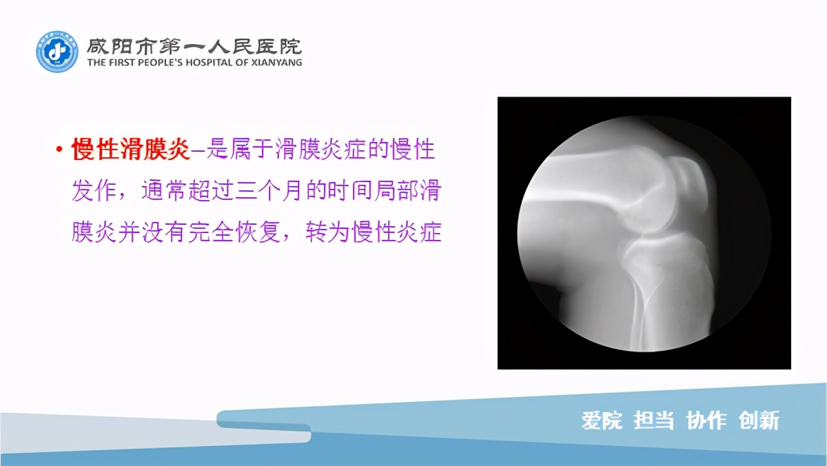 臭氧玻璃酸钠治疗膝关节炎怎么样,膝关节滑膜炎臭氧