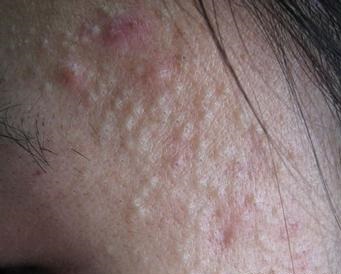 痘痘是如何形成的,痘痘是怎么形成的