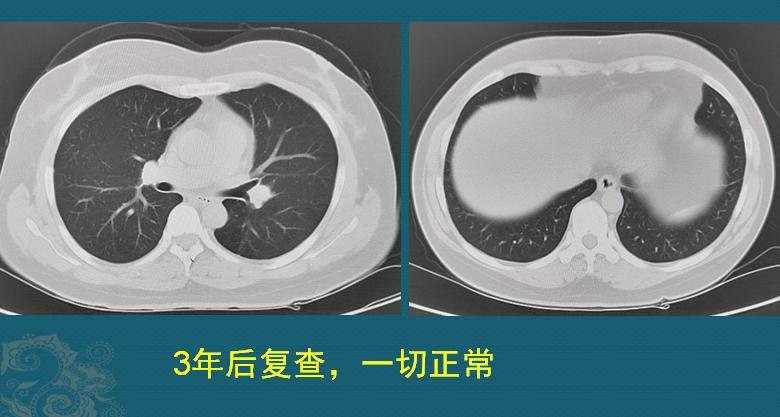 32岁女子抗癌19年相继患上5种癌,癌细胞转移最难治疗方法