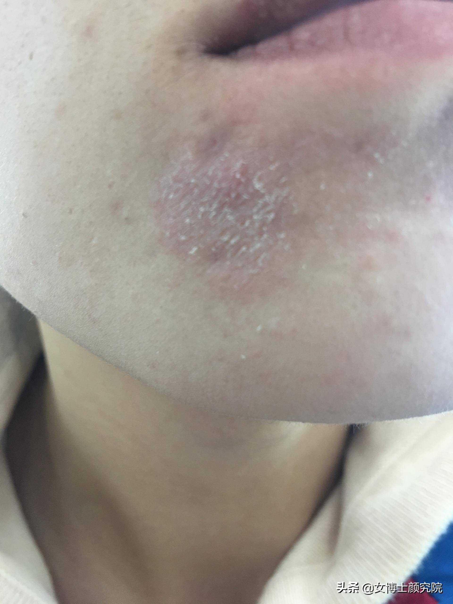 用了维a酸乳膏脸脱皮发红怎么办,刷酸脸红爆皮怎么办