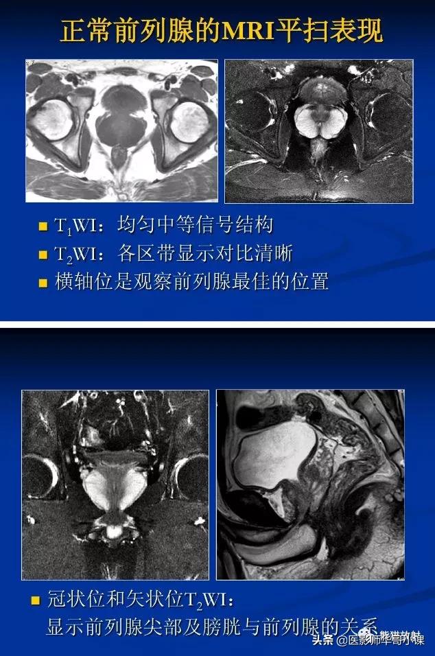 前列腺磁共振影像解剖,前列腺mri正常诊断报告模板