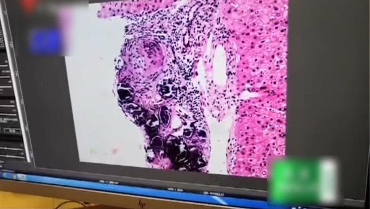 以为是单纯的慢性乙肝没想到上演了真人版“体内有虫”