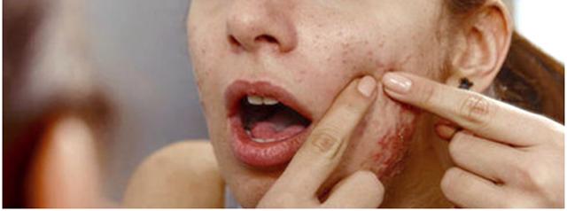 毛孔粗大满脸都是坑,毛孔粗大是糙皮病吗