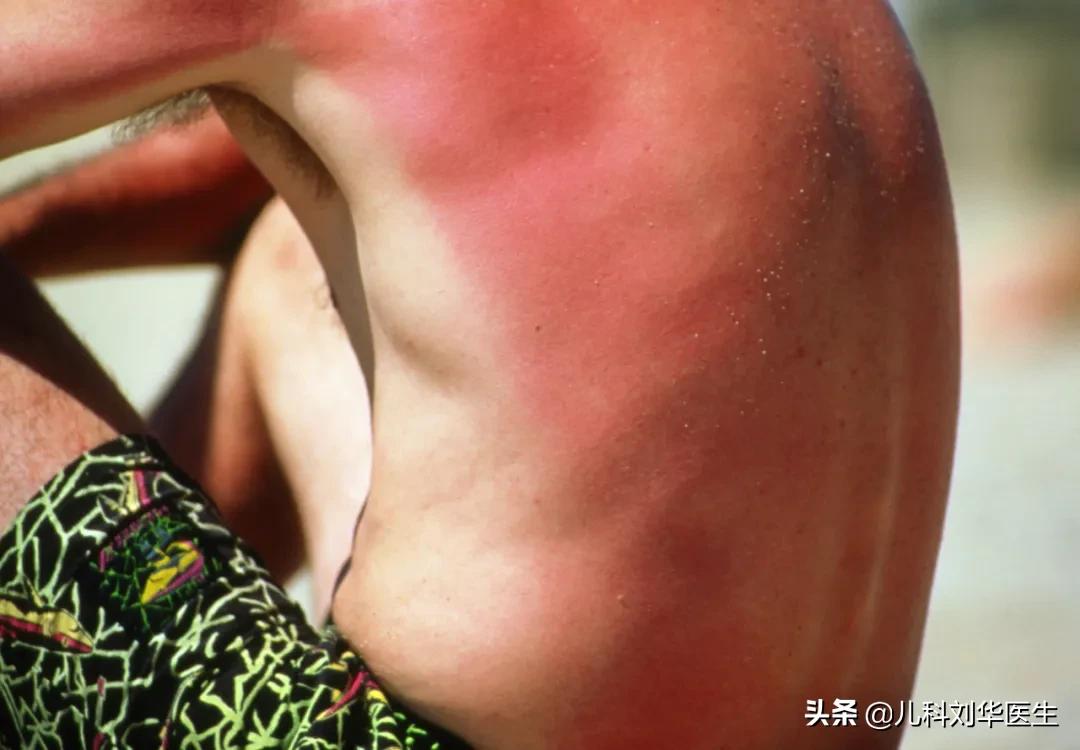 幼儿防晒小常识大全,儿童日常防晒怎么选择