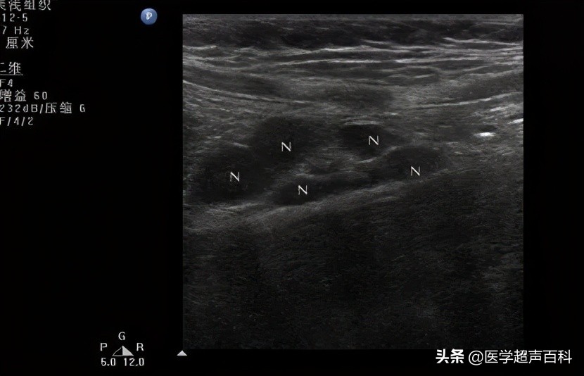 b超显示肠系膜淋巴结肿大,腹痛做b超可否看见肿瘤
